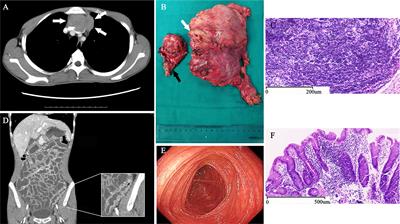 Case Report: MDM4 Amplified in a Thymoma Patient With Autoimmune Enteropathy and Myocarditis